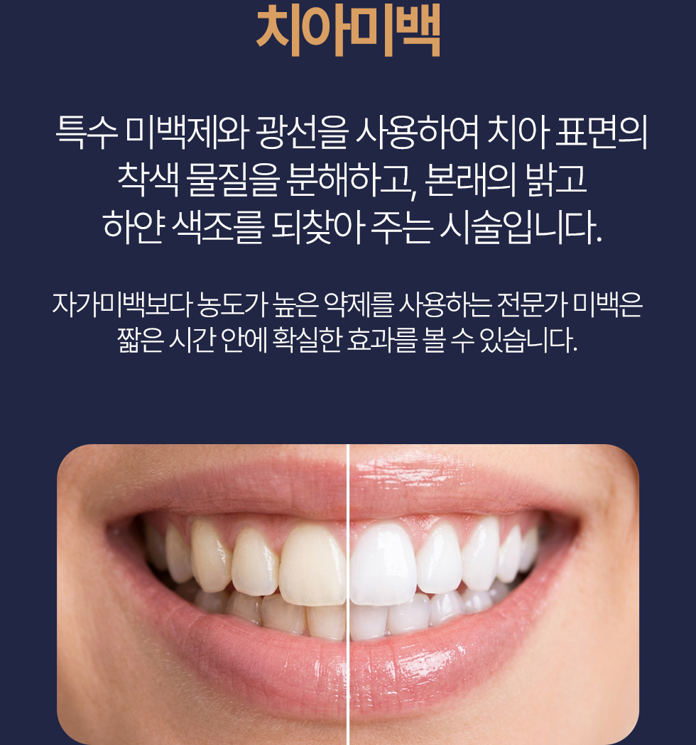 치아미백 특수 미백제와 광선을 사용하여 치아 표면의 착색 물질을 분해하고, 본래의 밝고 하얀 색조를 되찾아 주는 시술입니다. 자가미백보다 농도가 높은 약제를 사용하는 전문가 미백은 짧은 시간 안에 확실한 효과를 볼 수 있습니다.