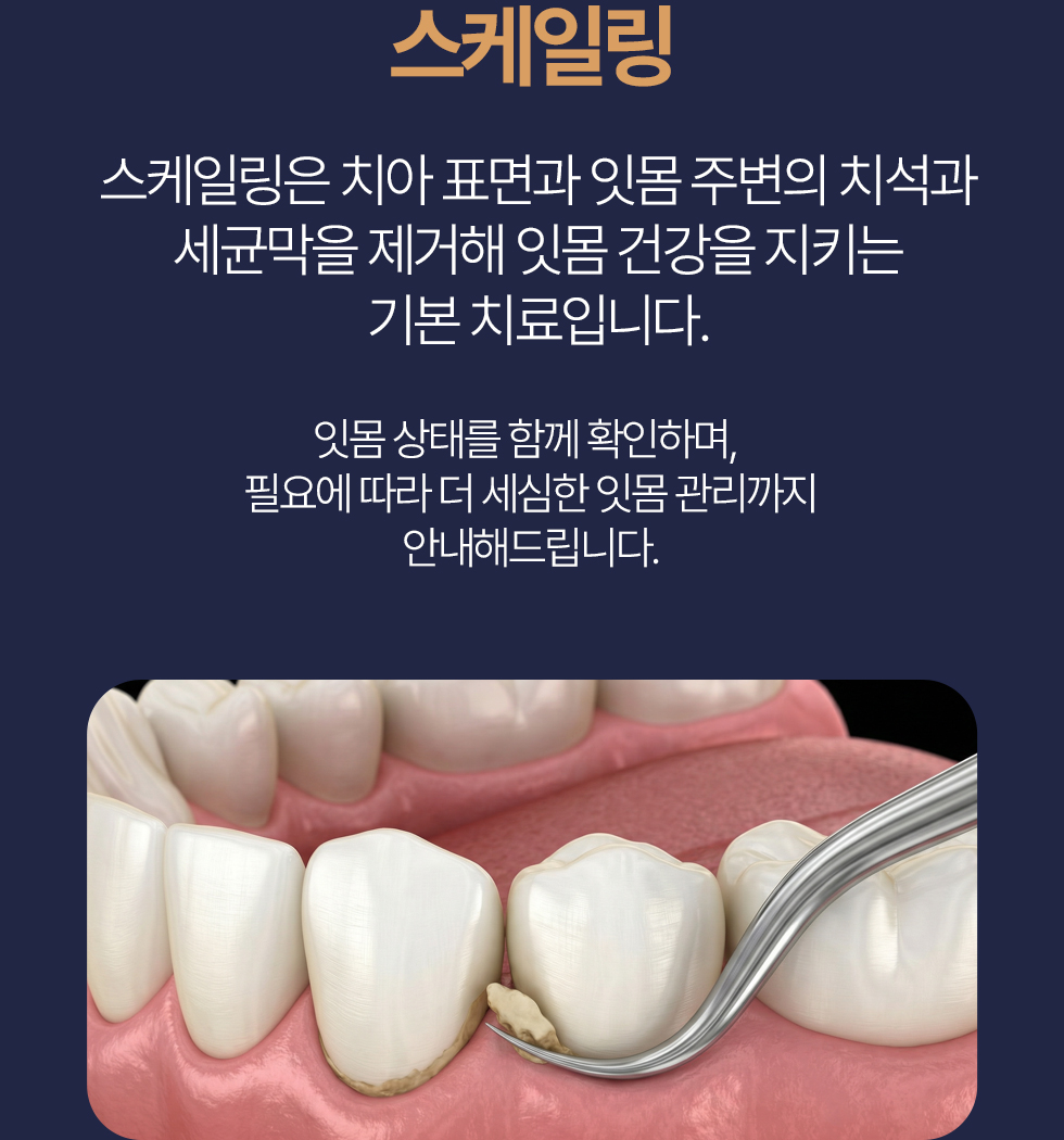 스케일링 스케일링은 치아 표면과 잇몸 주변의 치석과 세균막을 제거해 잇몸 건강을 지키는 기본 치료입니다. 잇몸 상태를 함께 확인하며, 필요에 따라 더 세심한 잇몸 관리까지 안내해드립니다.