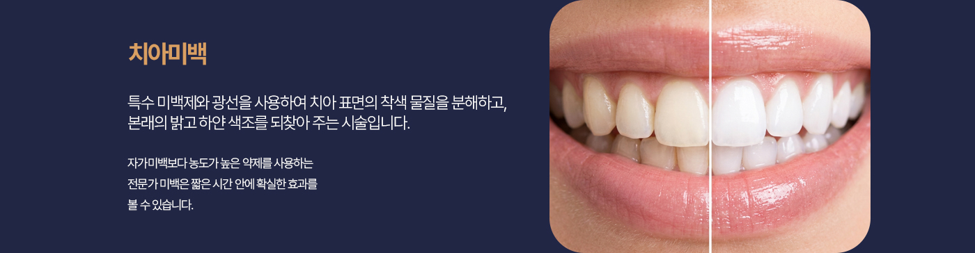 치아미백 특수 미백제와 광선을 사용하여 치아 표면의 착색 물질을 분해하고, 본래의 밝고 하얀 색조를 되찾아 주는 시술입니다. 자가미백보다 농도가 높은 약제를 사용하는 전문가 미백은 짧은 시간 안에 확실한 효과를 볼 수 있습니다.